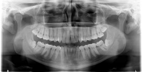 Impacted Wisdom Teeth Opg Image