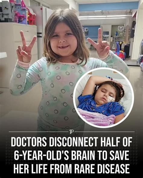Ss Doctors Disconnect Half Of 6 Year Olds Brain To Save Her Life From