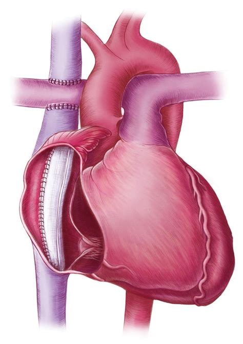 Fontan Procedure Published In Emj Cardiology On Behance Cardiology