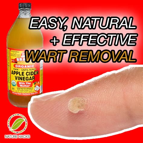 Natural Wart Removal Techniques