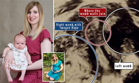 Mother With Two Vaginas Wombs And Cervixes Gives Birth After Doctors Said She Would Be Infertile