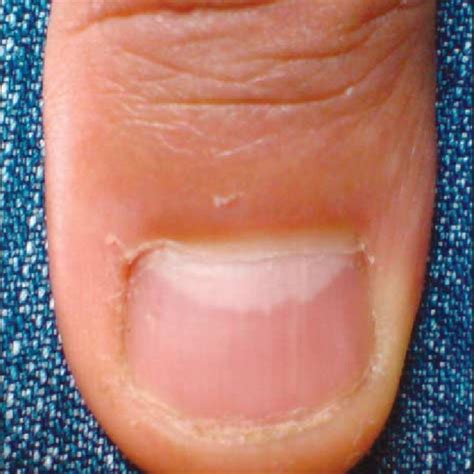 Onycholysis Oil Drop Discoloration Nail Bed Hyperkeratosis And