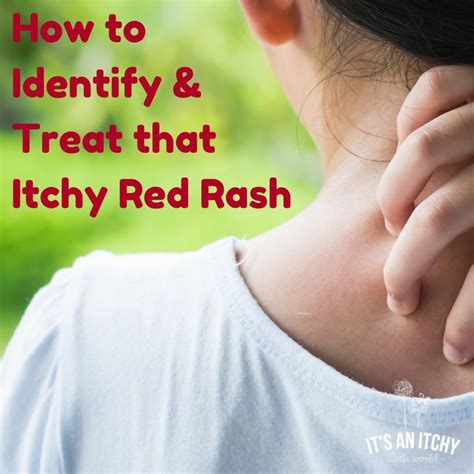 How To Identify And Treat That Itchy Red Rash