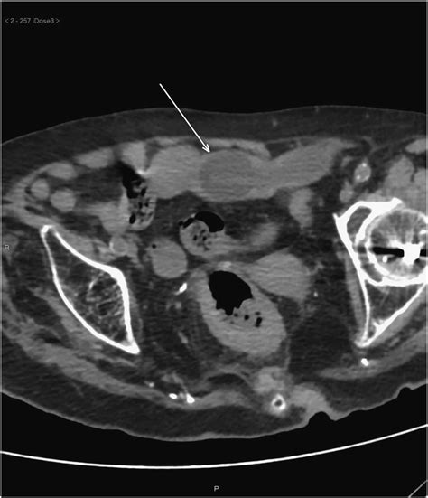 Single Axial Image Of Abdominal Ct Scan Without Contrast Demonstrating