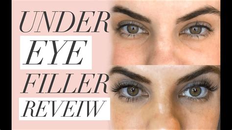 Under Eye Fillers For Under Eye Hollows And Darkness Before And After