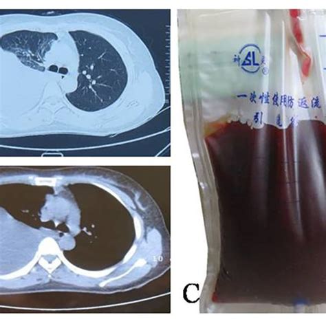 Cytological Examination Of Pleural Fluid In The Patient A