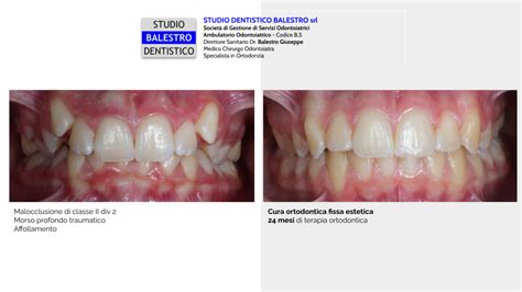 Studio Dentistico Balestro Malocclusione Di II Classe Div 2