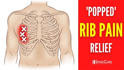 How To Fix A Rib Out Of Place Youtube