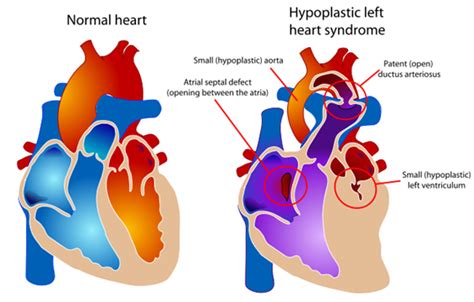 Pediatric Cardiothoracic Surgery Hypoplastic Left Heart Syndrome