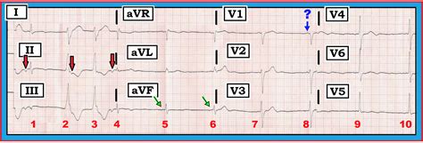 Ecg Interpretation Ecg Blog 107 — Ventricular Echo