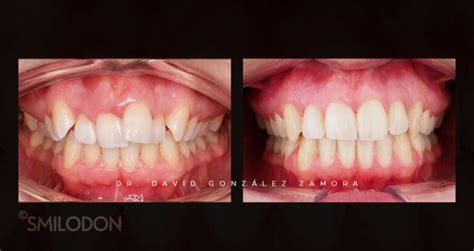 Casos Clínicos De Ortodoncia Clínica Dental Smilodon