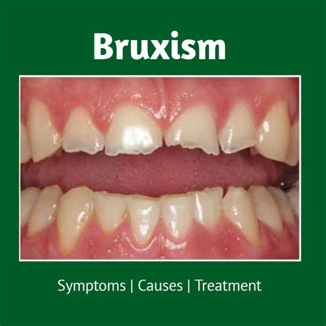 What Is Bruxism Symptoms Causes Treatment Microdent Dentistry