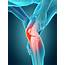 Human Knee Pain Photograph By Sebastian Kaulitzki/science Photo Library