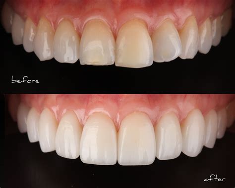 Smile Stylist Before And After Porcelain Veneers Dentes Dentes