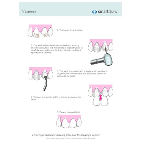 Dental Veneers Process