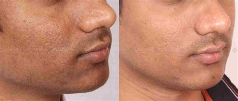 Skin Pigmentation Treatment Before And After Images