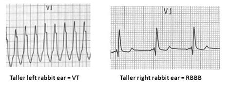 The Daily Educational Pearl Vt Vs Svt With Aberrancy Emergucate