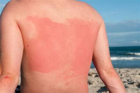 Remedies For Heat Rash And Guide On How To Prevent It