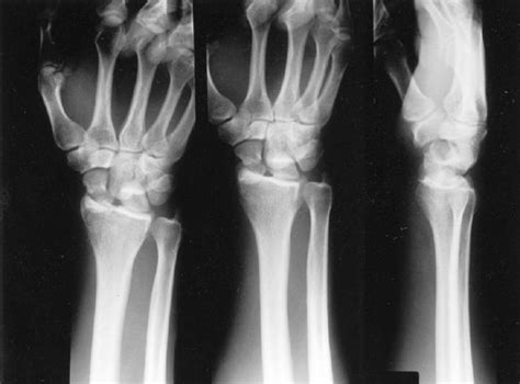 Radial Styloid Fractures Musculoskeletal Key