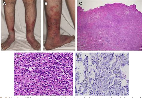Pdf Skin And Soft Tissue Infections Due To Nontuberculous Mycobacteria