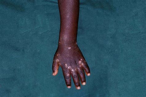 Scabies African American
