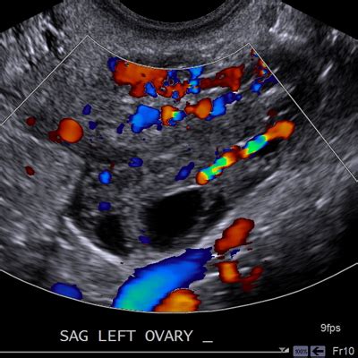 What is a female pelvic ultrasound? Female Internal Ultrasound - Noninvasive Ultrasound ...