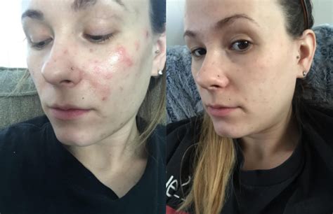 19 Skincare Products With Dramatic Before And After Photos