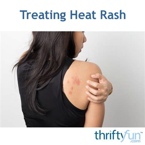 Treating Heat Rash Thriftyfun