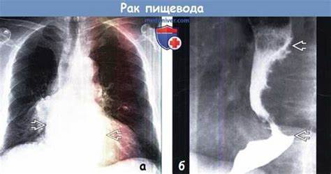 Диета при лейомиоме пищевода Рентгенограмма, КТ при лейомиоме пищевода Рентгенограмма, КТ при лейомиоме пищевода Диета при лейомиоме пищевода