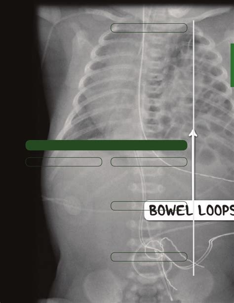 Upper Gastrointestinal Congenital Malformations Notes Diagrams