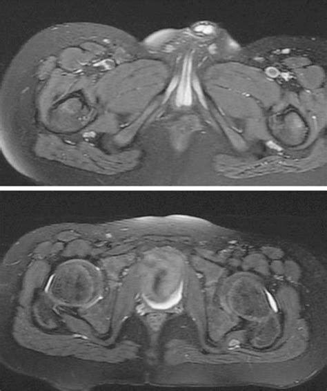 Mri Of The Proximal Sciatic Nerve A Axial Fat Suppressed T2 Weighted Download Scientific