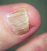Fingernail Eczema Treatment Photos