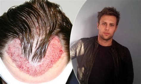 Man Who Spent Thousands On Botched Operations Tells How He Regained Hair Uk