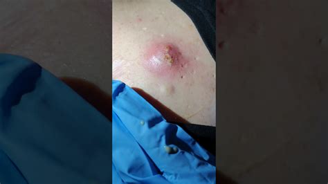 The Biggest Pimple Pop Of 2020 Exploding Spot Pimple Cyst Popping Please See Description