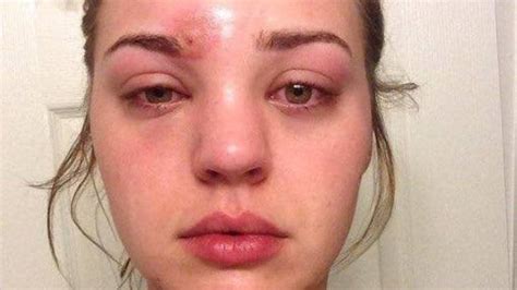 When Pimple Popping Turns Ugly And Dangerous Nz
