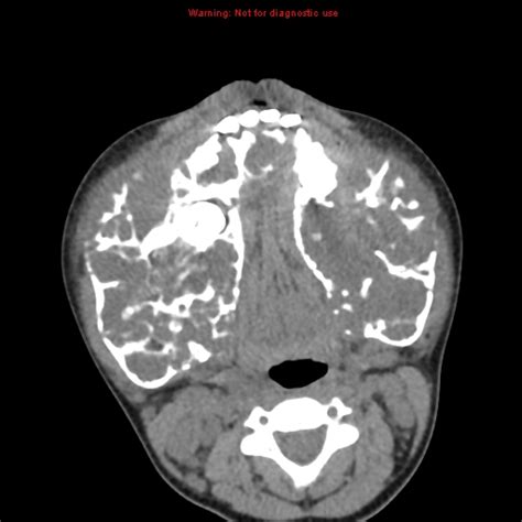 In most patients, cherubism is due to dominant mutations in the. Cherubism | Image | Radiopaedia.org