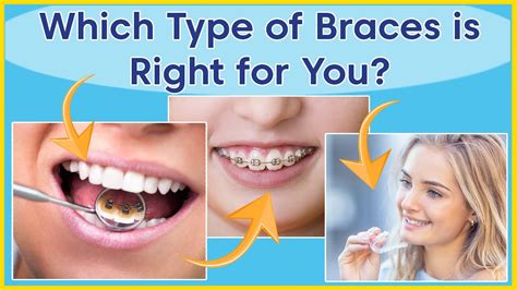 types of orthodontic treatment which braces are right for you youtube