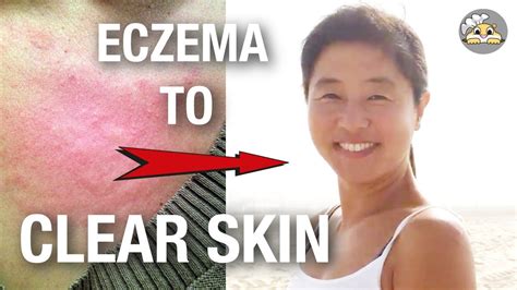 Eczema To Clear Skin My Story Youtube
