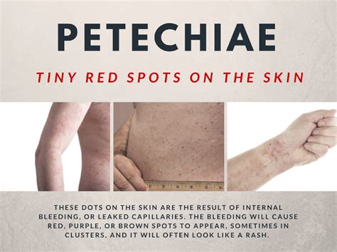 Tiny Red Spots On Skin Petechiae Causes And Treatments Aplastic