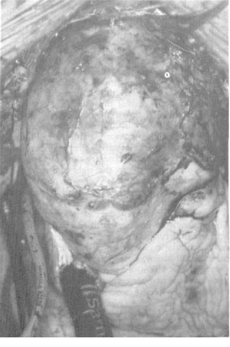 Figure 1 From Surgical Treatment Of An Aortopulmonary Artery Fistula