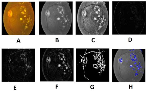 Detection Of Diabetic Retinopathy Using A Fusion Of Textural And