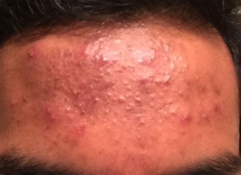 Small Bumps On Forehead Closed Comedones General Acne Discussion
