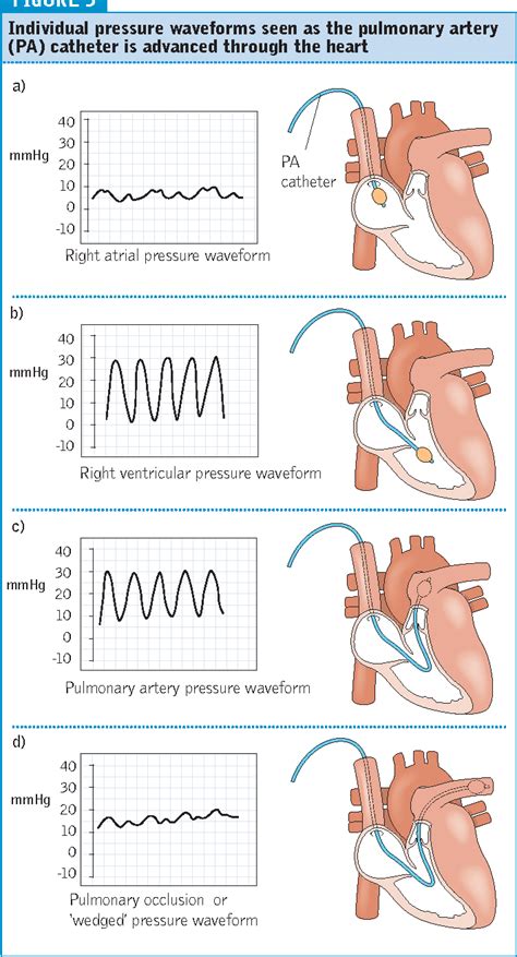 Figure 5 From A Practical Guide To Using Pulmonary Artery Catheters