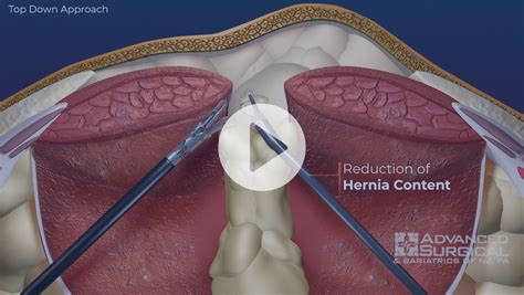 Incisional Hernia Advanced Surgical And Bariatrics Of Nj