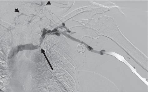 Digital Subtraction Angiography Demonstrates A Central Venous Stenosis