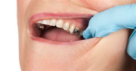 Early Signs Of Tooth Decay