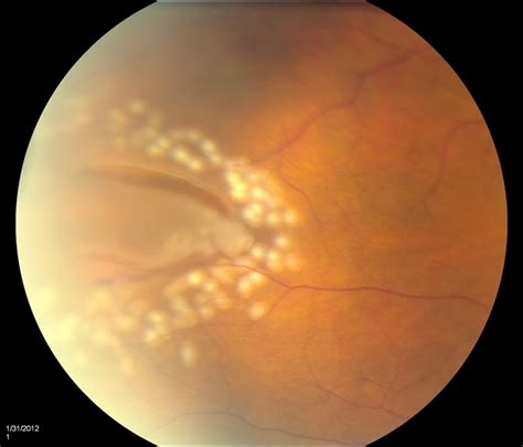 Check spelling or type a new query. Horseshoe Tear With Laser Treatment - Retina Image Bank