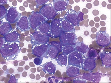 Pleural Fluid Overload Associated Large B Cell Lymphoma With A Formerly