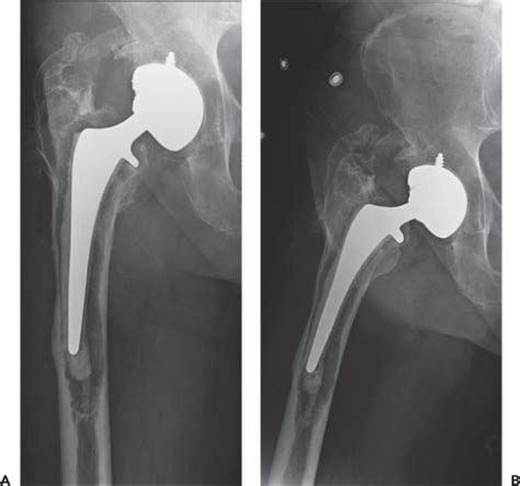 The Direct Lateral Approach For Revision Total Hip Arthroplasty