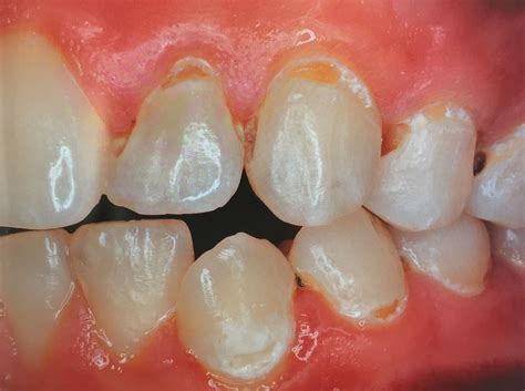Tooth Plaque Cheek Dental Blog